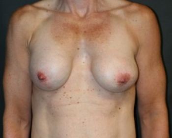 Breast Revision - Before & After - Dr. Placik