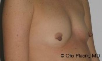 Nipple Reduction - Before & After - Dr. Placik