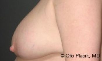 Nipple Reduction - Before & After - Dr. Placik