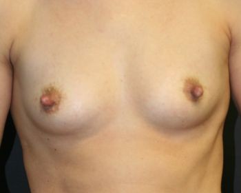 Nipple Reduction - Before & After - Dr. Placik