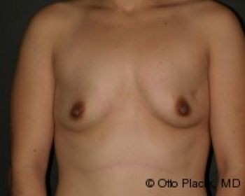 Before & After Breast Augmentation Gallery - Before & After - Dr. Placik