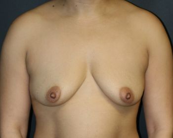 Breast Augmentation with Lift - Before & After - Dr. Placik