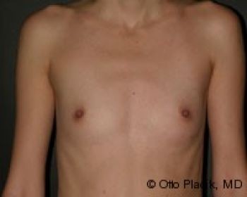 Before & After Breast Augmentation Gallery - Before & After - Dr. Placik