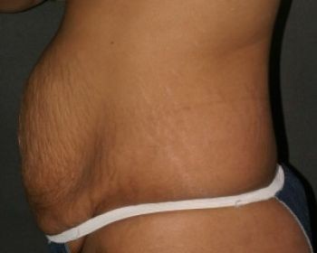 Tummy Tuck - Before & After - Dr. Placik