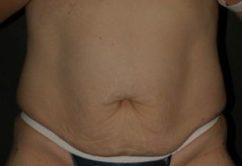 Tummy Tuck - Before & After - Dr. Placik