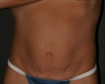 Tummy Tuck - Before & After - Dr. Placik