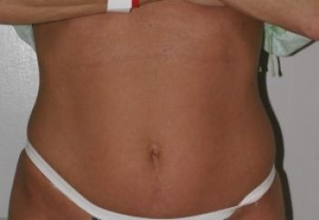 Tummy Tuck - Before & After - Dr. Placik