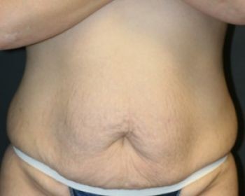 Tummy Tuck - Before & After - Dr. Placik