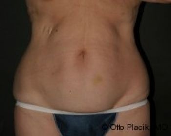 Tummy Tuck - Before & After - Dr. Placik