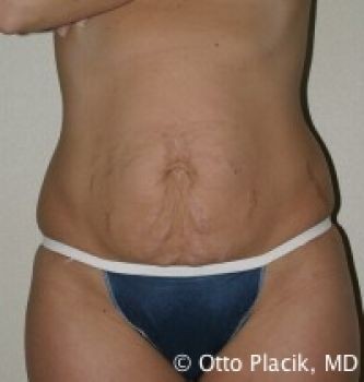 Tummy Tuck - Before & After - Dr. Placik