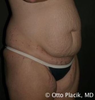 Tummy Tuck Chicago