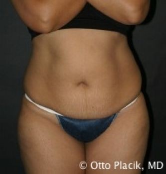 Tummy Tuck - Before & After - Dr. Placik