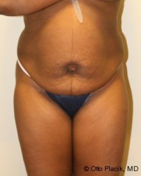 Tummy Tuck - Before & After - Dr. Placik