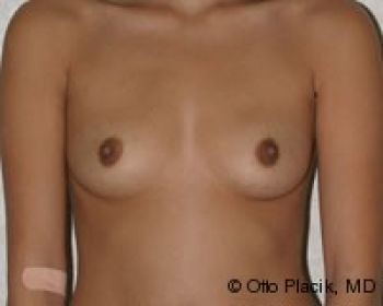 Before & After Breast Augmentation Gallery - Before & After - Dr. Placik