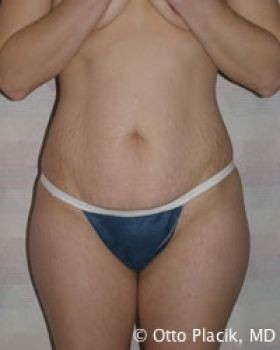 Tummy Tuck - Before & After - Dr. Placik