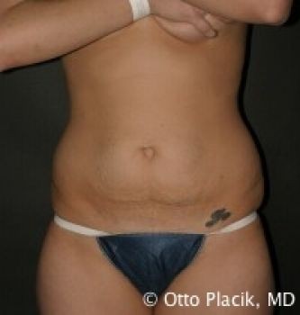 Tummy Tuck - Before & After - Dr. Placik