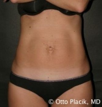 Tummy Tuck - Before & After - Dr. Placik