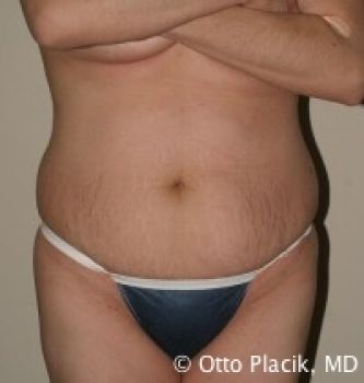 Tummy Tuck - Before & After - Dr. Placik