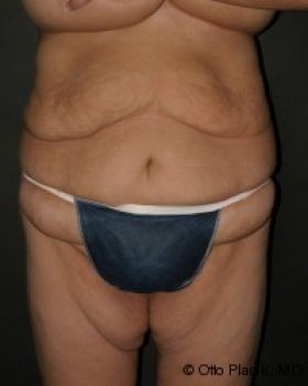 Tummy Tuck - Before & After - Dr. Placik