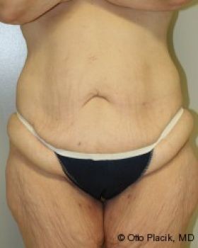 Tummy Tuck - Before & After - Dr. Placik