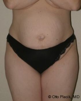 Tummy Tuck Chicago