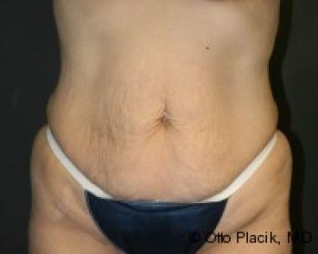 Tummy Tuck - Before & After - Dr. Placik