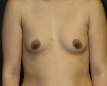 Before & After Breast Augmentation Gallery - Before & After - Dr. Placik