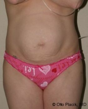 Tummy Tuck - Before & After - Dr. Placik