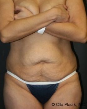 Tummy Tuck - Before & After - Dr. Placik