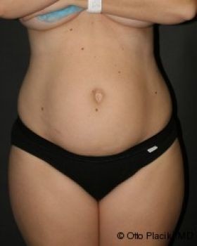 Tummy Tuck - Before & After - Dr. Placik