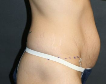 Tummy Tuck - Before & After - Dr. Placik