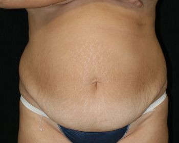 Tummy Tuck - Before & After - Dr. Placik