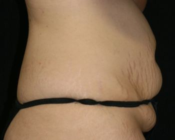 Tummy Tuck - Before & After - Dr. Placik