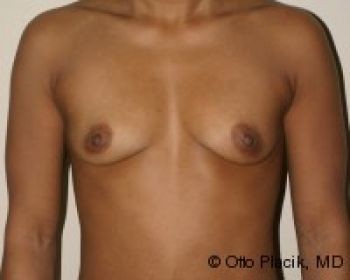 Before & After Breast Augmentation Gallery - Before & After - Dr. Placik