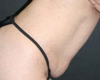 Tummy Tuck