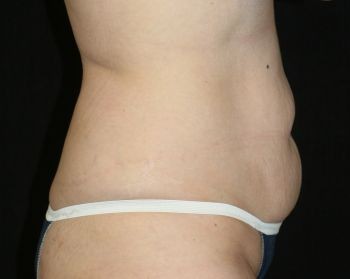 Tummy Tuck