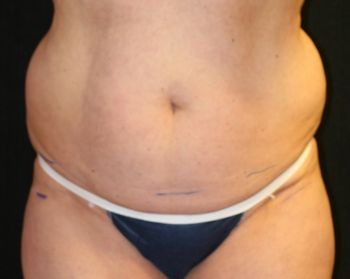 Tummy Tuck - Before & After - Dr. Placik