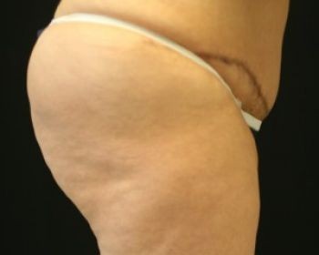 Liposuction Chicago