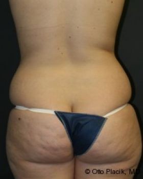 Liposuction - Before & After - Dr. Placik