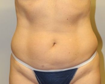 Liposuction - Before & After - Dr. Placik