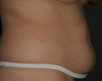 Liposuction - Before & After - Dr. Placik