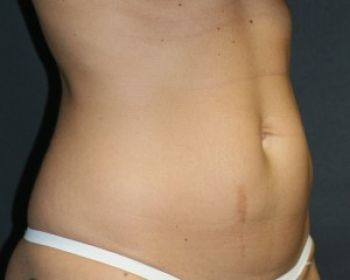 Liposuction - Before & After - Dr. Placik