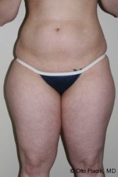 Liposuction - Before & After - Dr. Placik