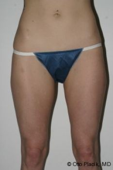 Liposuction - Before & After - Dr. Placik