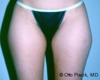 Liposuction - Before & After - Dr. Placik