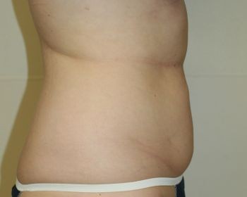 Liposuction - Before & After - Dr. Placik