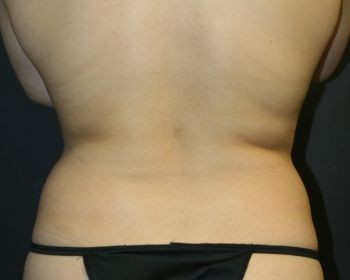 Liposuction - Before & After - Dr. Placik