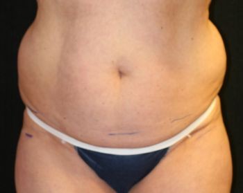Liposuction Chicago