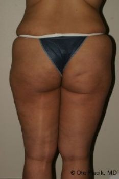 Butt Augmentation - Before & After - Dr. Placik