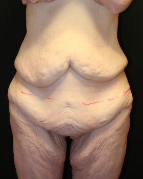 Thigh Lift - Before & After - Dr. Placik